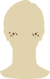 にきび